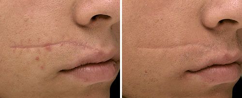 Facial Scar Treatment