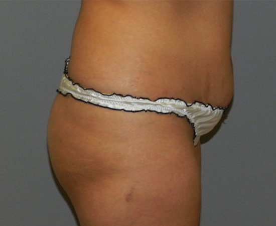 Newport Plastic-Body Contouring Result1