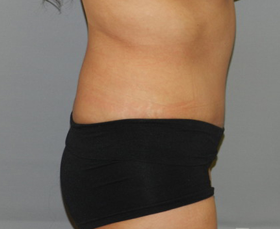 Newport Plastic-Body Contouring Result2