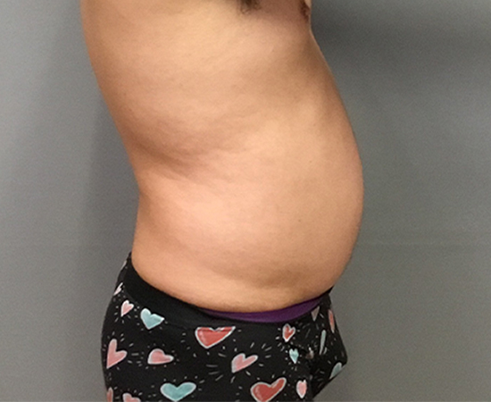 Newport Plastic-Body Contouring Result3