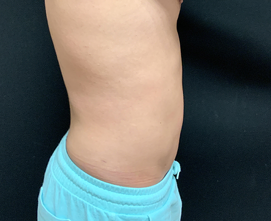 Newport Plastic-Body Contouring Result4