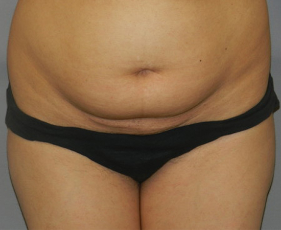 Newport Plastic-Body Contouring Result5