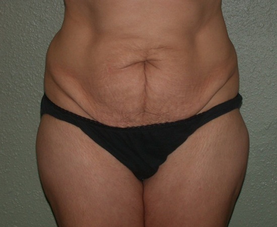 Newport Plastic-Body Contouring Result7