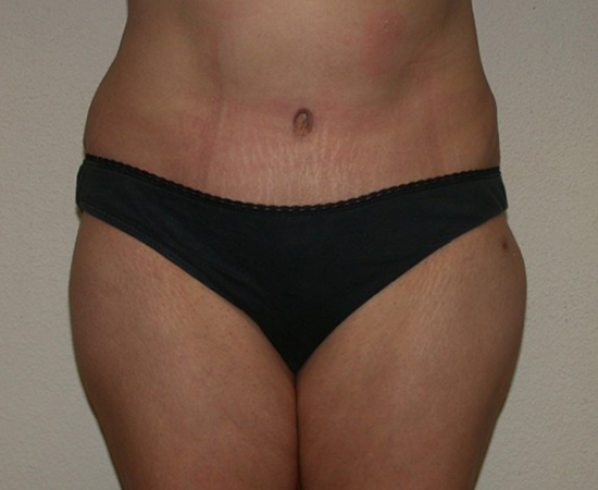 Newport Plastic-Body Contouring Result8