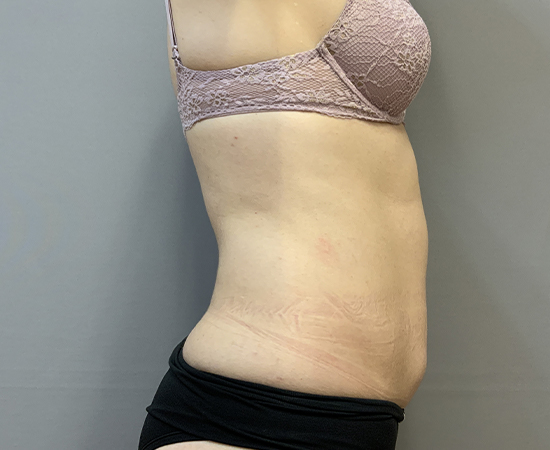 Newport Plastic-Body Contouring Result9