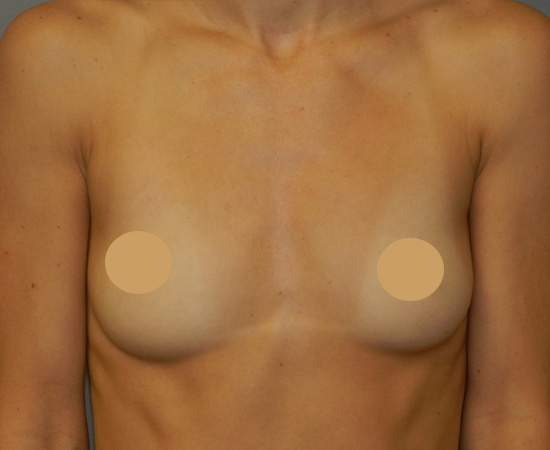 Newport-Plastic-Breast-Procedures-Breast-Augmentation-results1