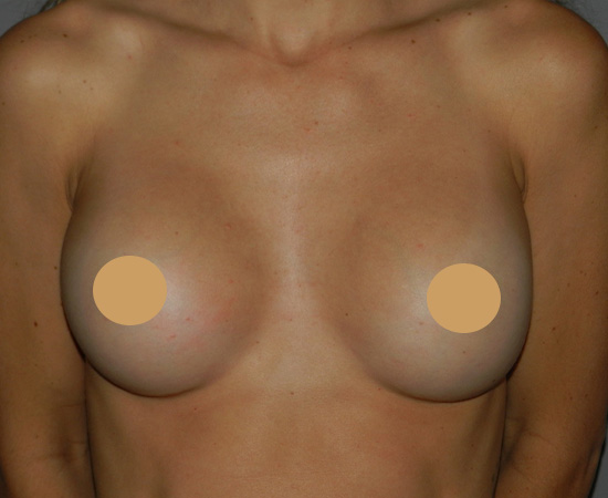 Newport-Plastic-Breast-Procedures-Breast-Augmentation-results2