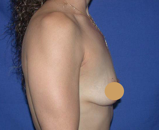 Newport-Plastic-Breast-Procedures-Breast-Augmentation-results3