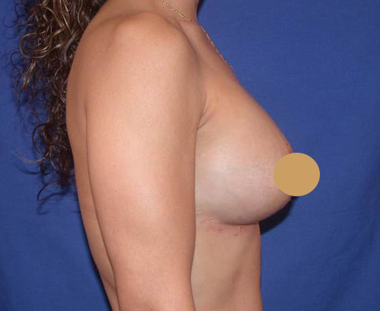 Newport-Plastic-Breast-Procedures-Breast-Augmentation-results4