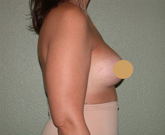 Newport-Plastic-Breast-Procedures-Breast-Augmentation-results6