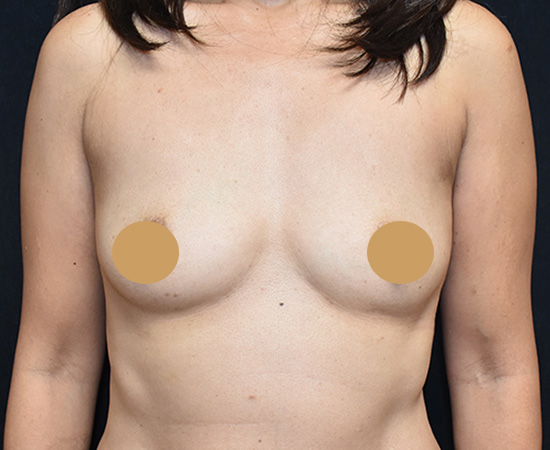 Newport-Plastic-Breast-Procedures-Breast-Augmentation-results7