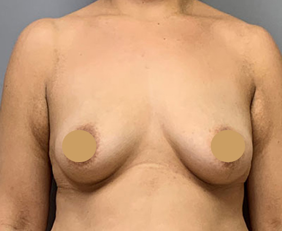 Newport-Plastic-Breast-Procedures-Breast-Augmentation-results9
