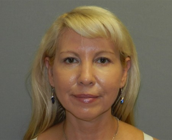 Newport Plastic Surgery-Face surgery result1