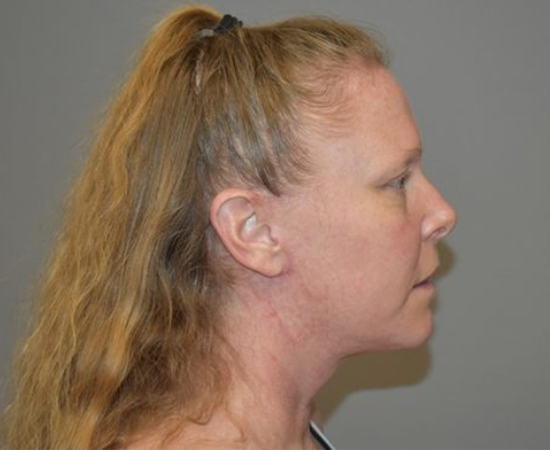 Newport Plastic Surgery-Face surgery result10