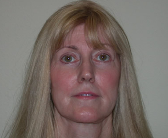 Newport Plastic Surgery-Face surgery result3