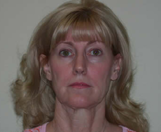 Newport Plastic Surgery-Face surgery result4