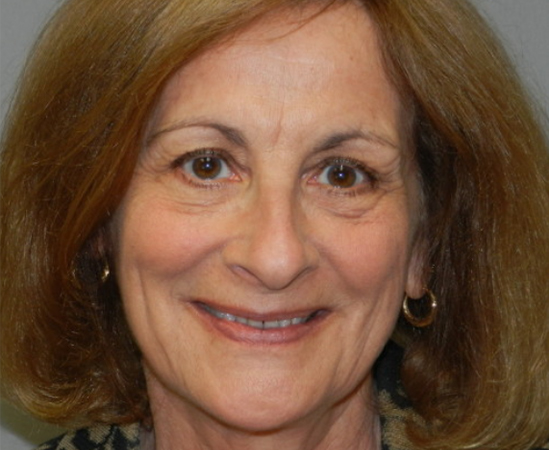 Newport Plastic Surgery-Face surgery result5