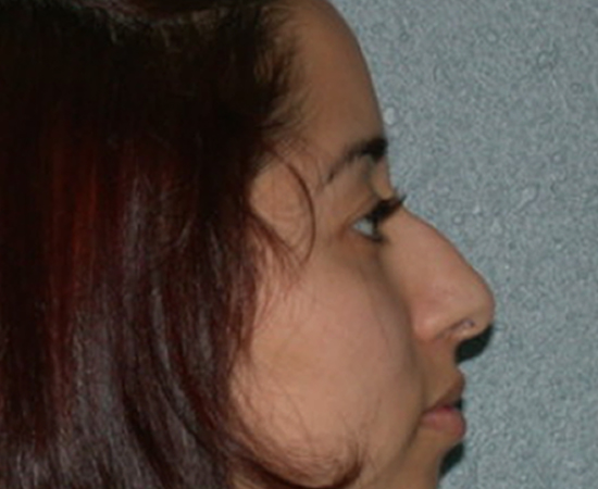 Newport Plastic Surgery-Face surgery result7