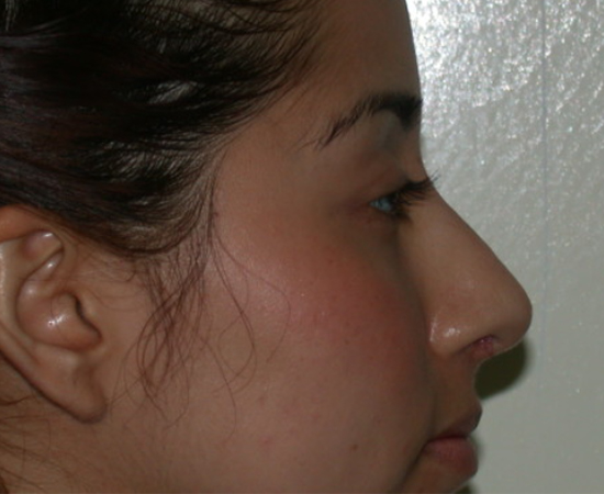 Newport Plastic Surgery-Face surgery result8