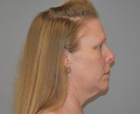 Newport Plastic Surgery-Face surgery result9