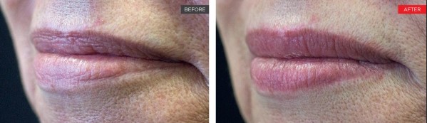 Newport-Plastic-Surgery-Lipase Result 1