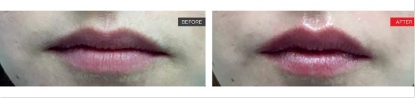 Newport-Plastic-Surgery-Lipase Result 3
