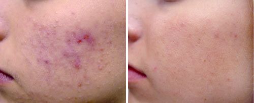 Acne Scar Treatment